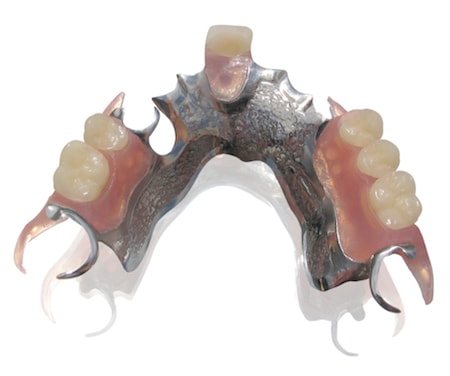 fixed partial denture all metal